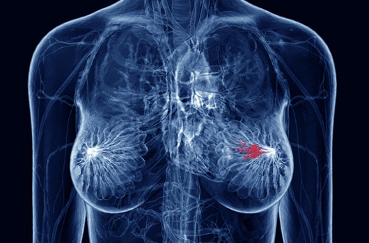 breast_cancer.jpg